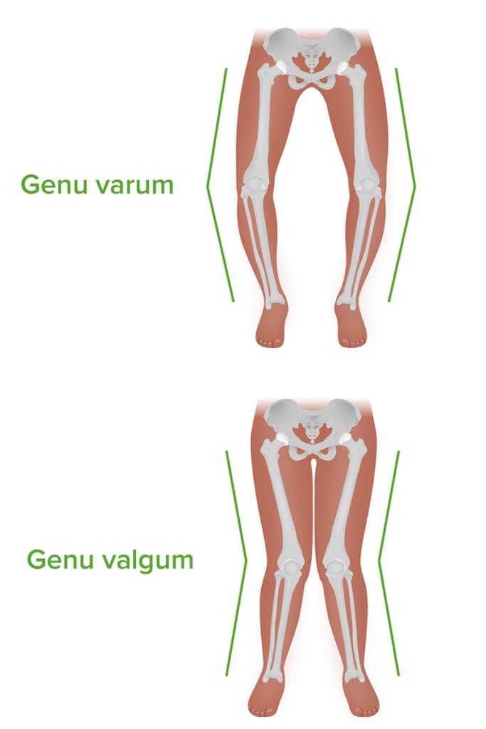 Genu-varum-and-valgum-683x1024 درمان زانو