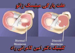 علت پارگی مینیسک زانو