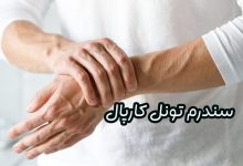 سندرم تونل کارپال