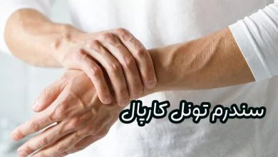 سندرم تونل کارپال