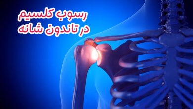 رسوب کلسیم در شانه
