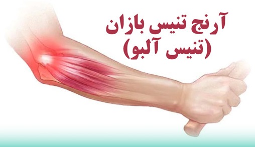 تنیس البو (آرنج تنیس بازان): علائم و درمان قطعی بدون جراحی