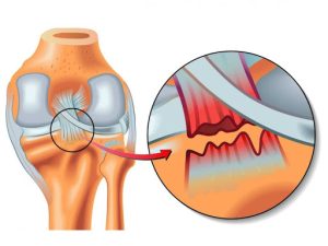 عزینه عمل رباط صلیبی زانو