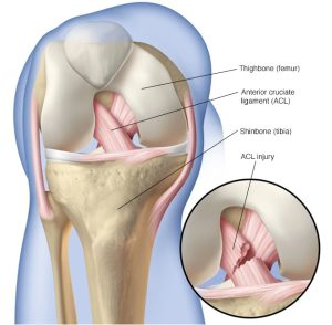 هزینه عمل رباط صلیبی زانو