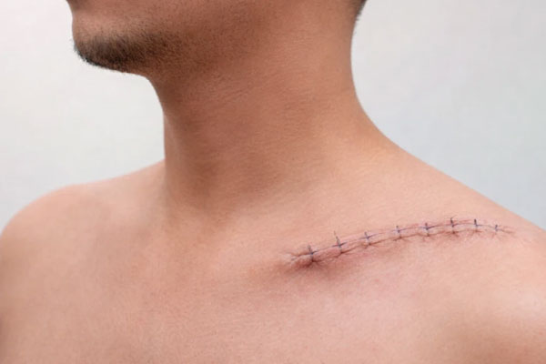 شکستگی ترقوه