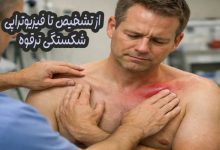 شکستگی ترقوه