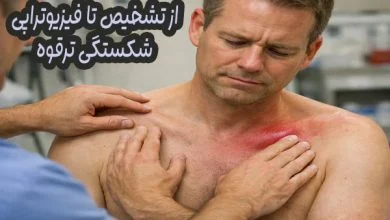 شکستگی ترقوه
