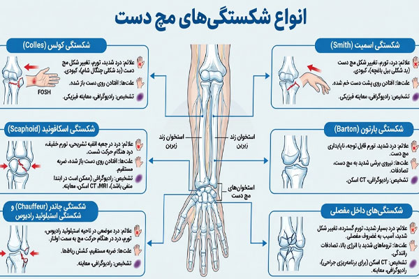 انواع شکستگی مچ دست