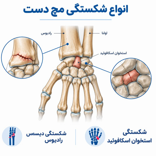 شکستگی مچ