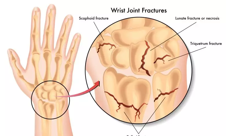 شکستگی مچ دست