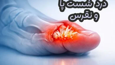 نقرس