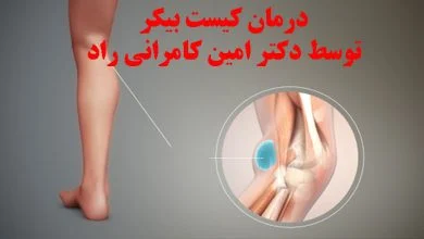 کیست بیکر