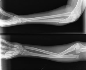 شکستگی ساعد دست