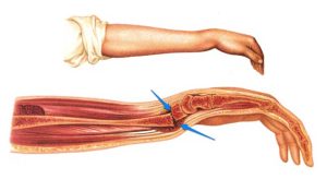 شکستگی ساعد دست