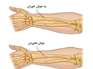 شکستگی ساعد دست