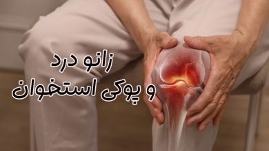 زانو درد ناشی از پوکی استخوان