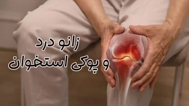 زانو درد ناشی از پوکی استخوان