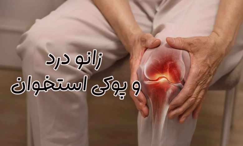 زانو درد ناشی از پوکی استخوان