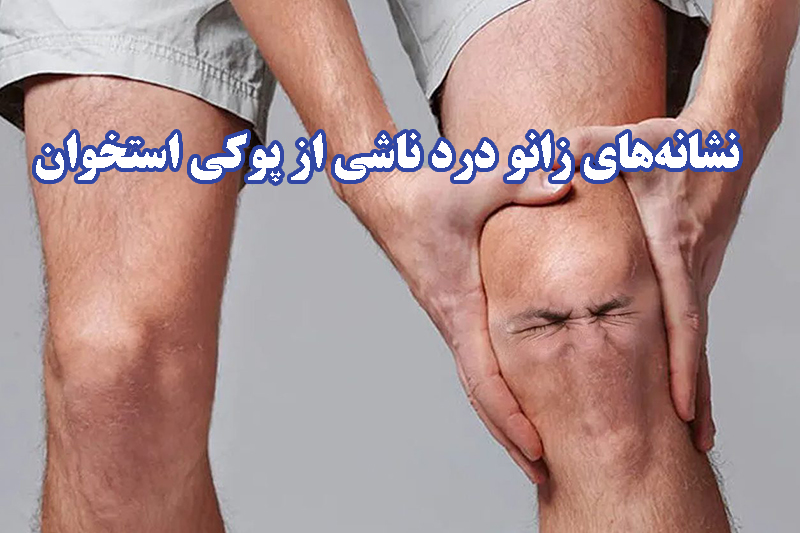 زانو درد ناشی از پوکی استخوان