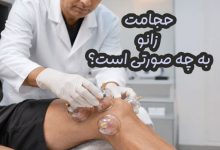 حجامت زانو