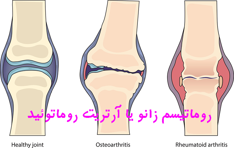 روماتیسم زانو