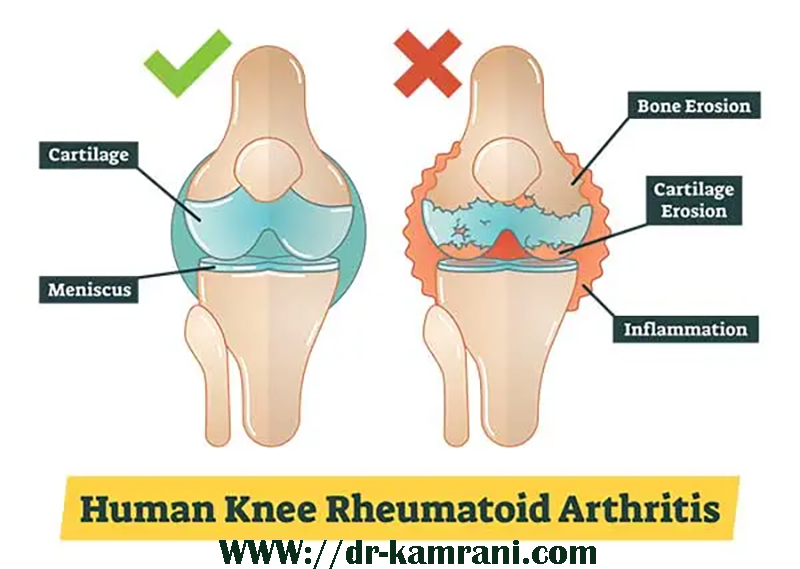 روماتیسم زانو