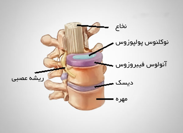 دیسک میان مهره ای