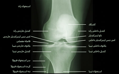 رادیوو رادیوگرافی زانو