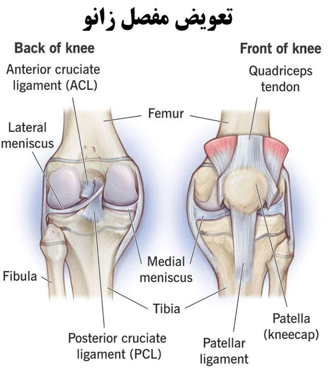 تعویض-مفصل-زانو