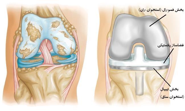تعویض مفصل زانو