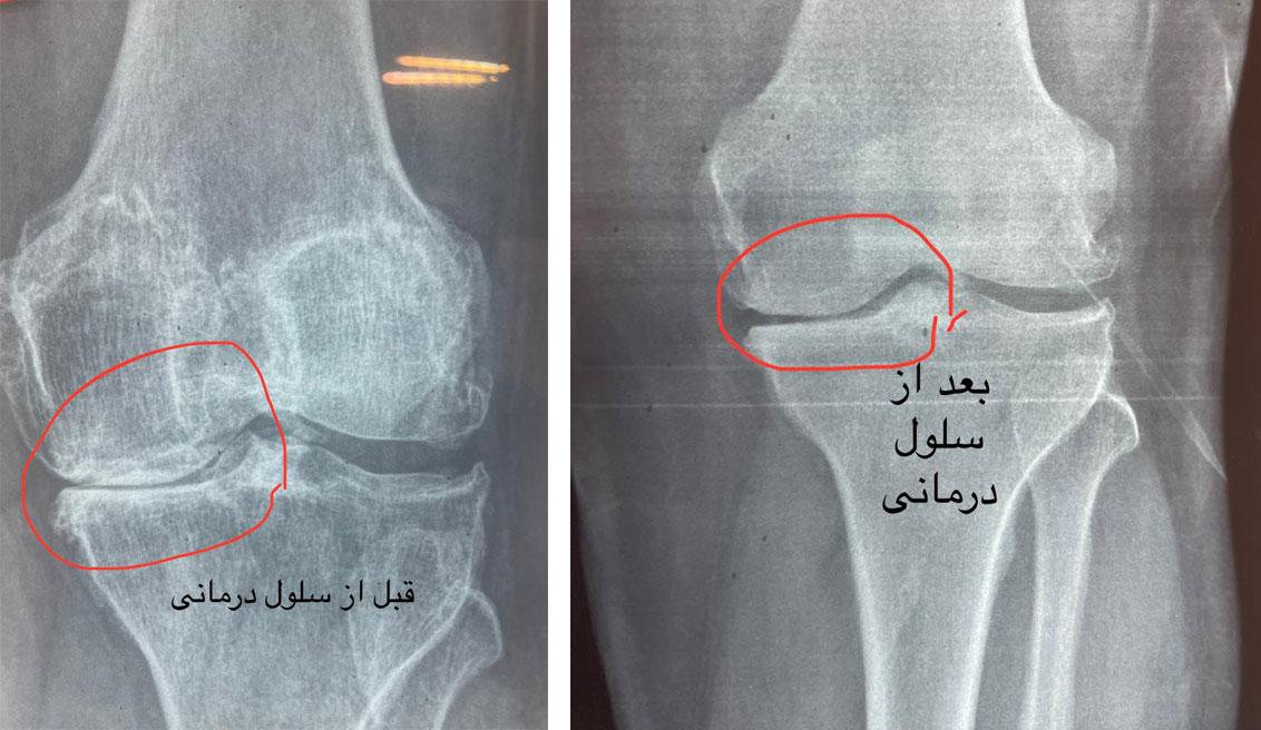 سلول درمانی غضروف زانو