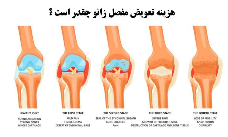 هزینه-تعویض-مفصل-زانو