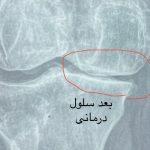 بهبودی چشمگیر غضروف زانو پس از سلول درمانی زانو