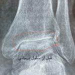 خانم 55 ساله با تخریب و درد شدید مچ پا از 8 سال قبل