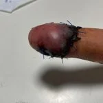 جراحی پیوند انگشت