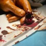بیمار باقطع بند اخر انگشت