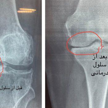 سلول درمانی زانو بیمار