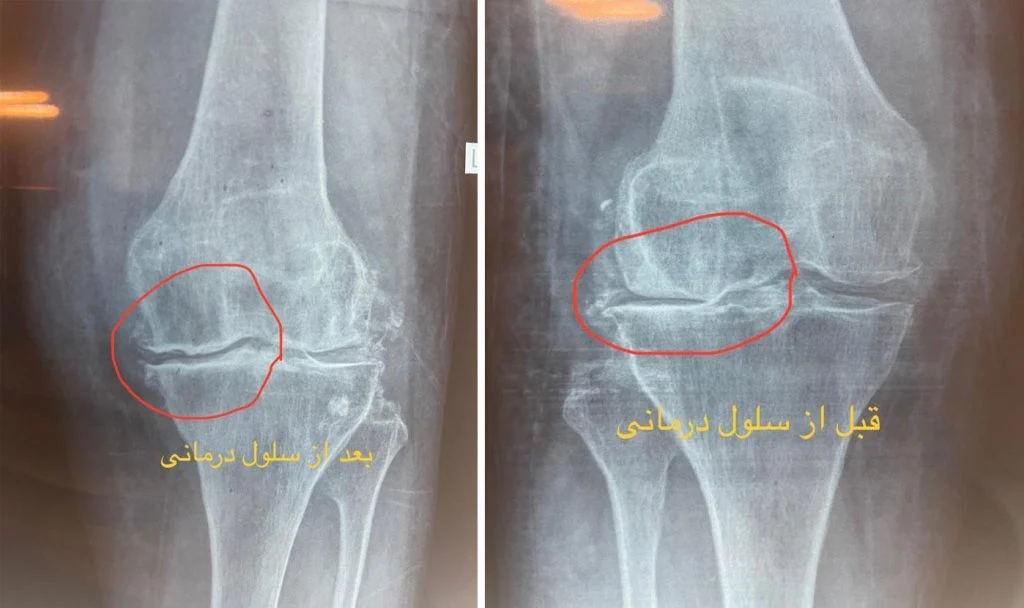 سلول بنیادی زانو