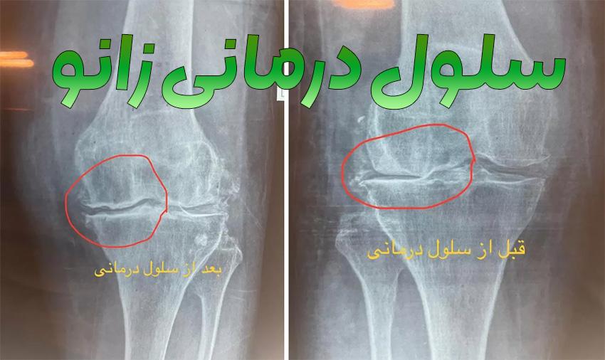 درمان زانو درد، از جراحی تا روشهای نوین بیولوژیک درمان زانو درد، از جراحی تا روشهای نوین بیولوژیک