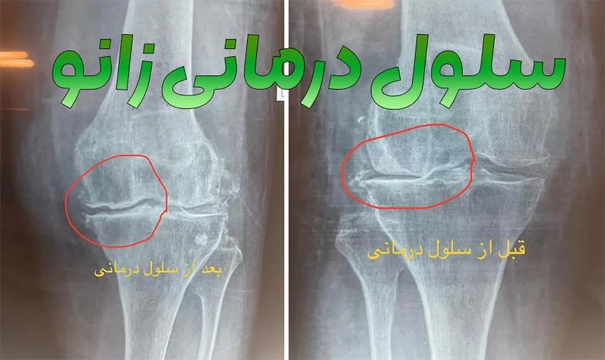 سلول-درمانی-زانو