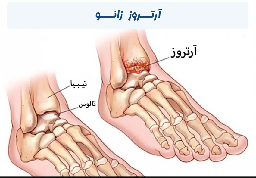 آرتروز زانو