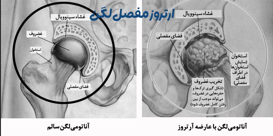 ارتروز مفصل لگن