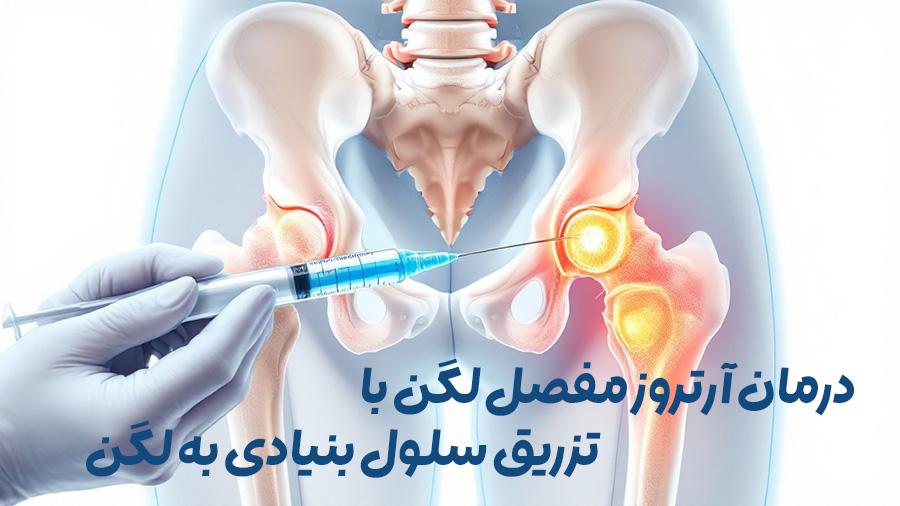 سلول-درمانی-ارتروز-لگن