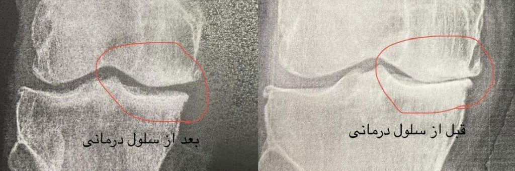 نتیجه سلول بنیادی در زانو