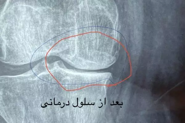 درمان آرتروز زانو و مفاصل بدن با سلول بنیادی مزانشیمال